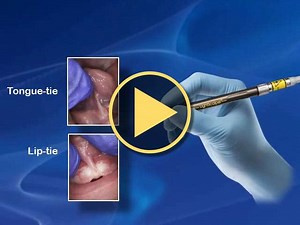 Infant Frenectomies with Lightscalpel Dental CO2 Laser - Video