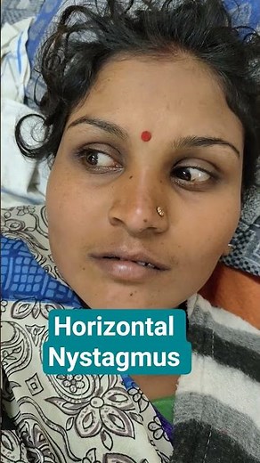 Horizontal Nystagmus #clinicalvideos