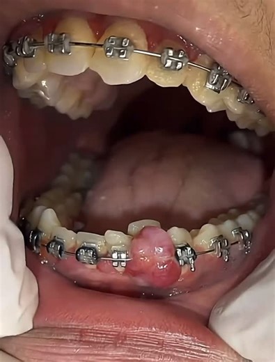 Dentite on Instagram: "Braces + a big gum bump? 😳 Here’s what it REALLY means… That swollen, red lump you see is usually a gum overgrowth (pyogenic granuloma) — a common reaction during orthodontic treatment. 🦷🔥 Why it happens: 🔹 Plaque trapped around brackets 🔹 Irritation from wires 🔹 Hormonal changes 🔹 Inflammation that grows FAST What to know: ✔️ It’s usually harmless ✔️ It can bleed easily 😬 ✔️ It makes brushing harder ✔️ Your dentist should check it to rule out anything else Treatme
