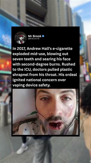 In 2017, Andrew Hall's e-cigarette exploded mid-use, blowing out