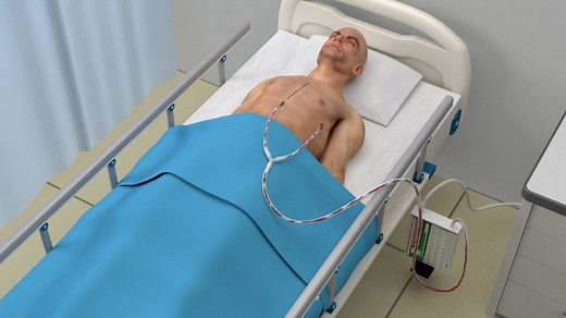 Thoraguard Intelligent Chest Tube Management