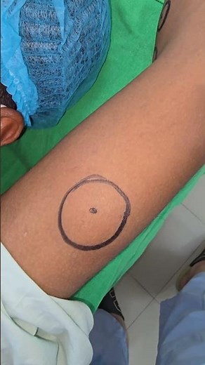 Lipomatosis