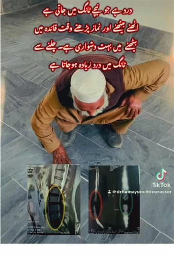 #CapCut #sciaticapain #chiropracticadjustment #drhumayunchiropractor #backpainrelief