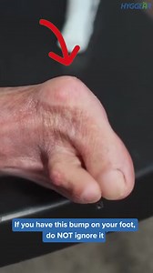 Say goodbye to bunion blues! 🌿 We've got a surgery-free solution to get you back into those beautiful shoes. Ready for happy, healthy feet? | Hyggear