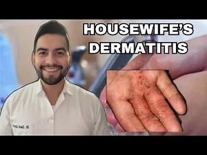 Contact Dermatitis Explained: Allergic, Irritant & Housewife's Dermatitis | Dr. David Campos