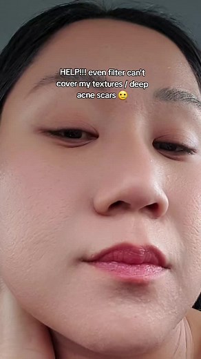 #acne #acnescar #beauty
