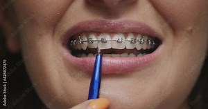 Teeth and braces brushing. Close up female cleaning enamel by orthodontic toothbrush. Dental hygiene, stomatology