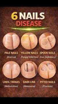6 Nail Diseases Your Body May Be Signaling 💅 What Your Nails Reveal