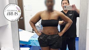 Don’t make the “arm mistake”! ⚠️ Most surgeons only treat the back of the arm — leaving the front, side, and shoulder untouched. That’s why so many patients end up doing arm liposuction twice. @celebrityarmsliposuction @artlipo_lipedema_surgery At ArtLipo in Tampa, Florida, Dr. Thomas Su performs Celebrity Arms™ Liposuction, a 360° awake arm sculpting technique that removes up to 90% of fat around the entire arm for complete, athletic definition. 💪 ✨ Full-circumference precision.� ✨ Visible mus