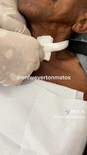 Cuidados de Enfermagem em Traqueostomia: Guia Prático