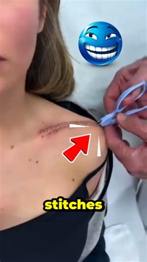 Why Doctors Use Metal Staples Instead of Stitches