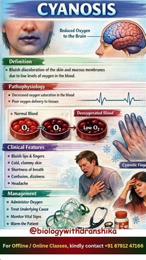 When oxygen drops, the body shows it cyanosis speaks through a bluish hue #cyanosis #healthawareness