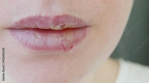 Close up of girl lips affected by herpes. Treatment of herpes infection and virus. Part of young woman face, lips with herpes affected. Beauty dermatology concept