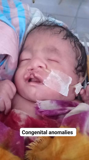 Congenital anomalies of new born baby #lowbirthweight #NICU #congenitalanomalies | Medical practice