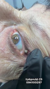 😳 It looked small, but wait till you see the ending! #drpimplepopper #grossaddiction | Pimple Popping