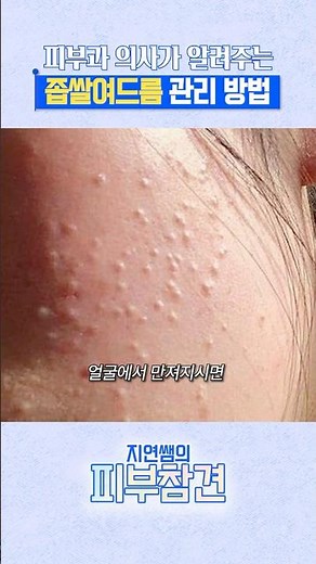 좁쌀 여드름 없애는 가장 확실한 방법