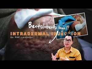The Classical PRP Injection Technique, Really Hard to do? | Intradermal Injection dr. Irfan Prasetya