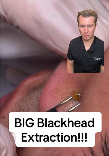 Satisfying Big Blackhead Extraction