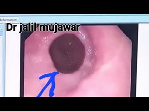 Schatzki rings .oesophageal ring present at lower end of oesophagus.
