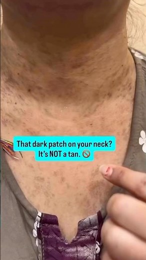 Why Your Neck Has Grey-Brown Patches (It’s NOT a Tan) | LPP Laser Treatment #skincare