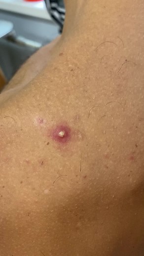 робота однією рукою) #прыщикнаспине #прищ #pimplepopper #прыщ #прыщик #pimple #mrpimple #давитьпрыщ