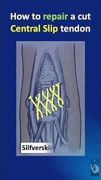 Shorts # 176: How to repair extensor tendon at Central slip level when we have more than 1 cm stump