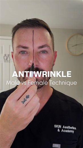Botox – Male vs Female Technique Ever wondered why we don’t inject Botox the same way for men and women? Here’s a side-by-side example on my own face but keep reading because it’s not that simple… This reel shows how I might approach Botox differently depending on someone’s facial features and desired outcome. But let me be super clear: 👉 Every face must be assessed individually during consultation. This example works best for someone who doesn’t yet have strong static wrinkles. If there are vi