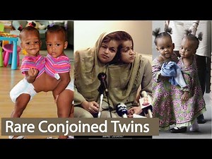 Top 5 Rare Conjoined Twins। Conjoined Twins Separated Successfully । Born Different
