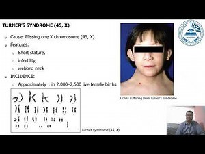 ANEUPLOIDY AND UNIPARENTAL DISOMY IN HUMANS
