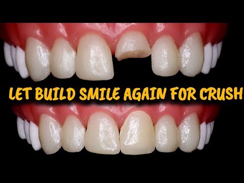 🔴Brocken front teeth repair well for my girl