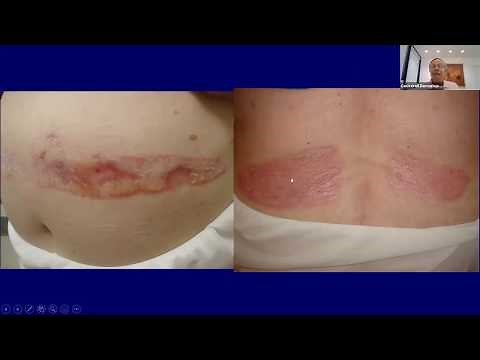 Autoimmune Connective Tissue Diseases