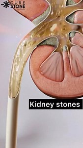 Struggling to decide between RIRS, PCNL, or Lithotripsy? 🤔💊 Here is the only rule you need to know! 👇 Your kidney stone size dictates the surgery, not just the doctor’s preference. 🔹 30mm: You might need PCNL – A small cut in the back to handle the heavy lifting. ⚠️ Choosing the wrong procedure can lead to incomplete removal. Save this reel so you never forget! 💾 Need a second opinion on your reports? 📲 WhatsApp your reports on 918800263884 for free consultation for kidney stones #kidneyst