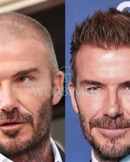 🚨 Why Do People Lose Hair After a Transplant? 🚨 A hair transplant relocates hair, but it doesn't cure the root causes of hair loss. Here are the 3 real reasons behind post-transplant thinning: 1. The Ongoing Fight with DHT 🧬 Transplanting hair doesn't stop genetic hair loss. Without proper DHT blockers, your original (native) hair behind the transplant will continue to thin and recede, ruining the overall density. 2. Hidden Nutritional Deficiencies 🩸 Hair follicles need a rich environment to
