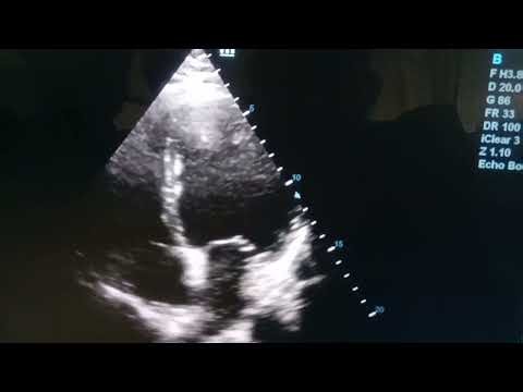 Severe LV dysfunction LVEF 30