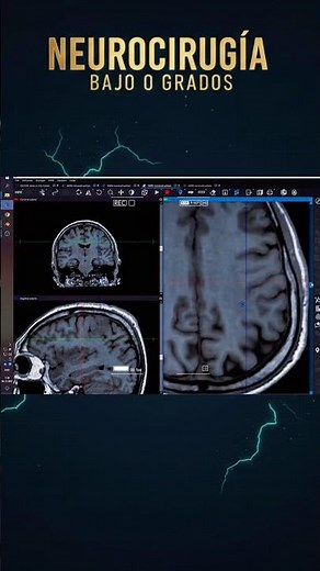 NEUROCIRUGIA 3D 🎖️🚀 #neurocirugía #cerebro