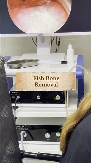 🐟 Fish Bone Stuck in Throat! Doctor’s Quick Removal by Endoscope #fishboneremoval #entdoctor #throat