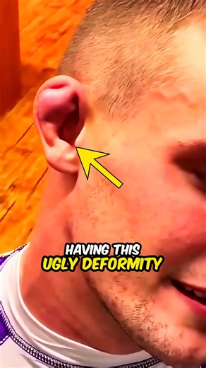 EMSRY Facts on Instagram: "Why You Should Never Fight A Guy With This Ear 👂🛑 It's called "Cauliflower Ear," and it is the ultimate mark of a professional fighter (MMA, Wrestling, Boxing). It acts as a warning sign that says "I can hurt you." But here is the crazy part: some fake tough guys are now paying to get their ears smashed just to look dangerous without actually fighting! 🔨😱 Would you ruin your ears for respect? Let me know in the comments! 👇 #mma #fighting #wrestling #ufc #cauliflow