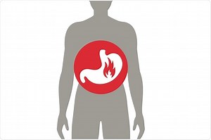 What is Gastritis?