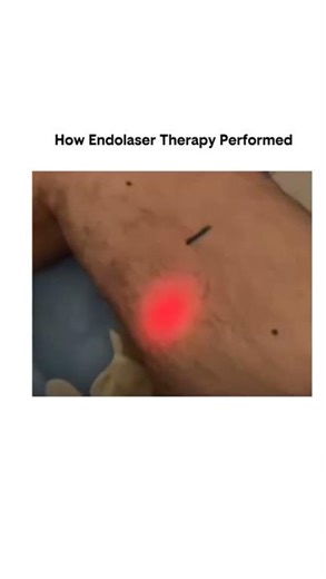 How Endolaser Therapy Performed #shorts #motivation #education #neet #science