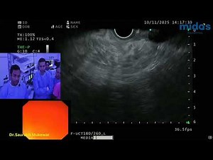 Live EUS-Guided FNB | Performed by Dr. Saurabh Mukewar | MIDAS Hospital Nagpur