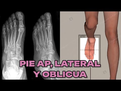 AP, LATERAL AND OBLIQUE FOOT X-RAY (POCKET MANUAL) #6