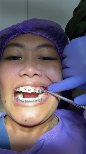 Braces Journey: Chain and Elastics Combo Explained
