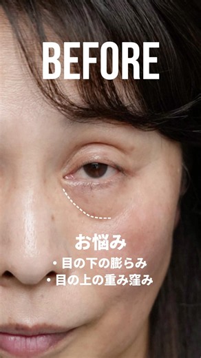 【50代女性クマ治療眼瞼下垂治療】 #クマ取り #クマ治療 #目の下のクマ #眼瞼下垂 #rootsclinic