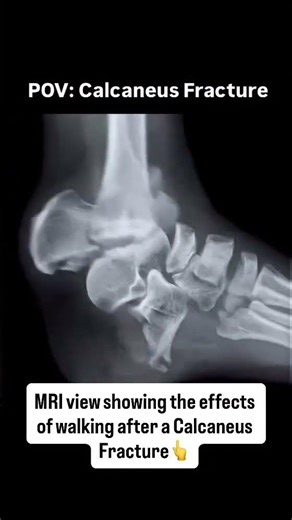 calcaneus Fracture....