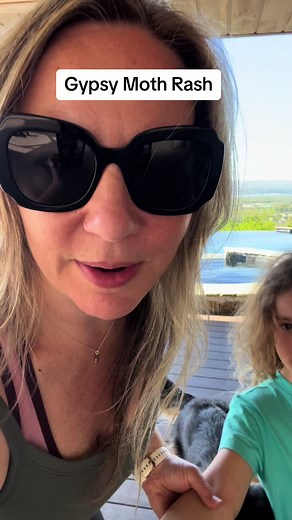 What is up with the gypsy moths causing rashes this year? any of you having this problem? ##gypsymoths##hudsonvalleyny##momsoftiktok