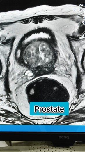 MRI prostate #anatomy #healthcare #healthtips #anatomysnippets #mriprostrate