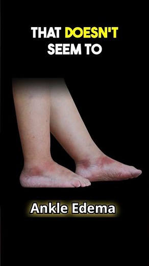 What Causes Ankle Edema/Swelling in The Elderly?