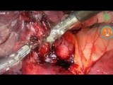 The World's first Versius Robotic Lobectomy • Video • MEDtube.net
