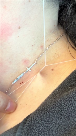 I DONT OFFER THIS AS A SERVICE Skintag Removel is something I do it only to make my friends feel more confident if it’s bothering them. #skintag #threading #fyp #satisfying #friends