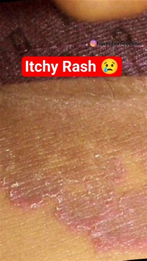 Fungal Infection Starts Small… But Spreads Fast | Don’t Ignore These Signs